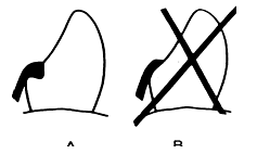 Fig. 4: A.- La preparación adecuada del descanso asegura la dirección axial de las tensiones; B.- efecto sobre plano inclinado por una preparación incorrecta. Jacobson,(1988