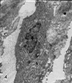 Fig. 4: Célula de la línea sarcomatosa. Obsérvese la presencia de núcleo irregular (rombo), de abundante retículo endoplasmático rugoso (cabeza de flecha). En el espacio extracelular existen abundantes fibrillas de colágeno (estrella) X. 24.000