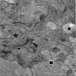 Fig.1. En esta micrografia electrónica, flecha: mitocondria; cabeza de flecha: tonofilamentos; estrella: RER y polisomas libres; círculo: pseudovacuola; cuadrado: espongiosis. Aumento: 20000x