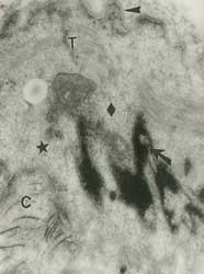 Fig. 10: En esta micrografía electrónica, estrella-área desprovista de miofilamentos; rombo-partículas de glucógeno; T-túbulo T; flecha-núcleo; cabeza de flecha-pliegues del sarcolema; C-colágeno. Aumento: 22.500X.