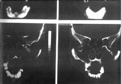 Fig.4: TAC de senos paranasales con lesión ocupante de espacio (LEO).