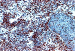 Foto Nº 7 Linfocitos T citotóxicos CD8+ en tejido de Estomatitis Aftosa Recurrente 10X