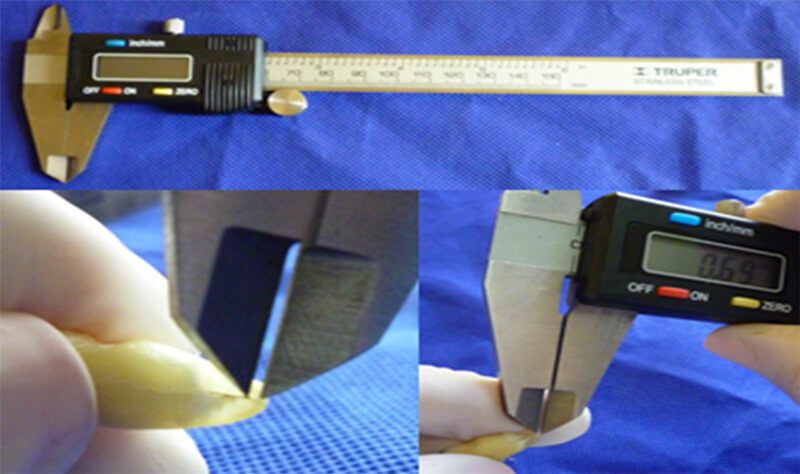 Foto 9. Medición  desde la punta de la lima al foramen mayor (mm) con el calibrador digital