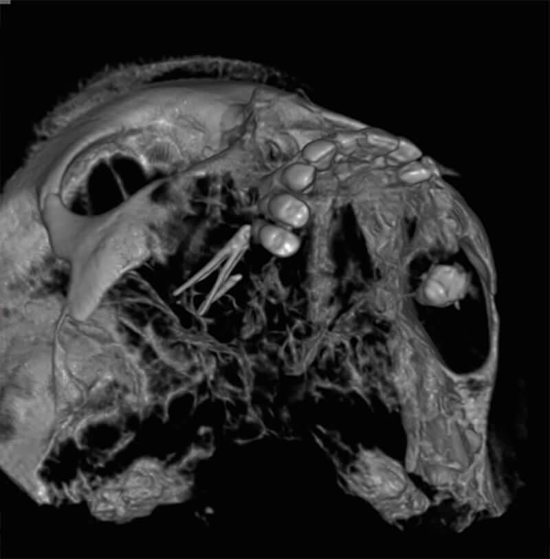 Figura 2. Imagen 3D mediante tomografía volumétrica: Conos de gutapercha en el  seno maxilar derecho, comunicación oroantral. Fuente propia