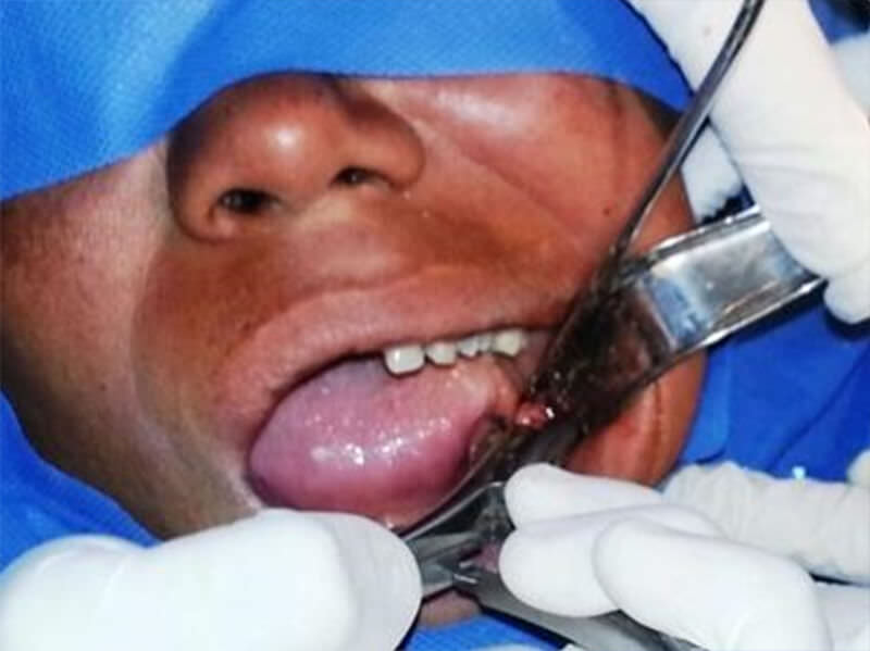 Figura N° 18: Tracción de diente 3.8 con fórceps