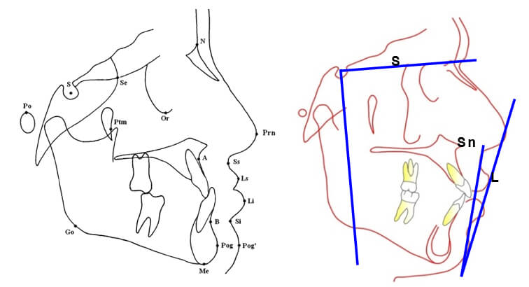 Fig.2. Puntos, líneas y planos de referencia cefalométricos. Línea E Labio superior, labio inferior.  Línea SnPg´ Labiosuperior, Labio inferior, SN-VS