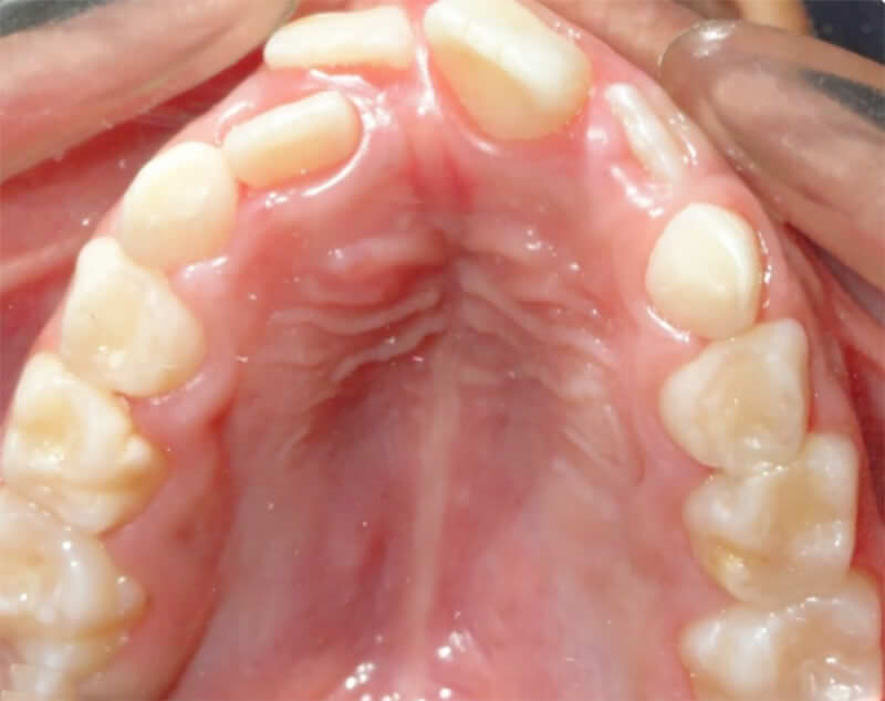 Imagen 16: Fotografía intraoral oclusal superior luego de 9 meses