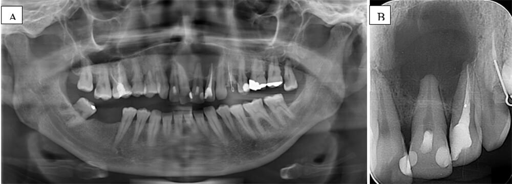 Figura 1(A)	Radiografía panorámica que muestra una lesión en los órganos dentarios 21 y 22; (B) Radiografía periapical que muestra la lesión apical en dientes 21 y 22