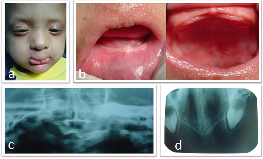 Fig. 1. Fotografías Preoperatorias: a. Fotografía extraoral donde se observa las características faciales. b. Fotografías intraorales donde se observan las características de la cavidad oral c.