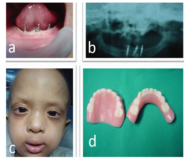 Fig. 3. Fotografías Pos-operatorias al mes a) implantes en zona anterior, b) radiografía panorámica mostrando los implantes colocados c) aspecto facial del paciente, d) dentaduras ya confeccionadas