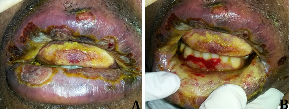 Figura 4A e 4B Condición bucal pos-transplante demostrando las señales de la DEVH aguda. Fuente propia
