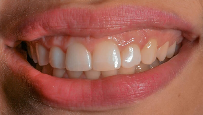 Figura 1.A) Vista frontal de la sonrisa del paciente; B) vista intraoral de los dientes anteriores. Las imágenes  evidencian  elaspecto  de  sonrisa  gingival  con  presencia  de  exostosis  y  asimetría  del margen gingival y dientes cortos.