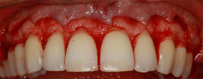 Figura  8. Vista  frontal  de  la  región  de  premolares  a  premolares,  evidenciando  la  realización  de desplazamiento de colgajo a espesura total.