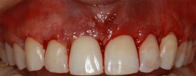 Figura 11.Aspecto inmediato de la relacion del tejido gingival y corona clínica dental despues de la realizacion de sutura con puntos simples con hilo Vycril 6.0.