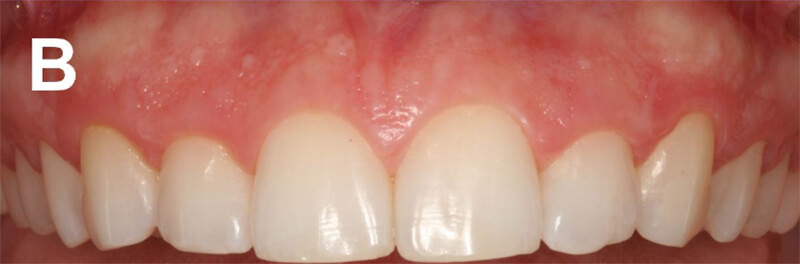 Figura 1.A) Vista frontal de la sonrisa del paciente; B) vista intraoral de los dientes anteriores. Las imágenes  evidencian  elaspecto  de  sonrisa  gingival  con  presencia  de  exostosis  y  asimetría  del margen gingival y dientes cortos.