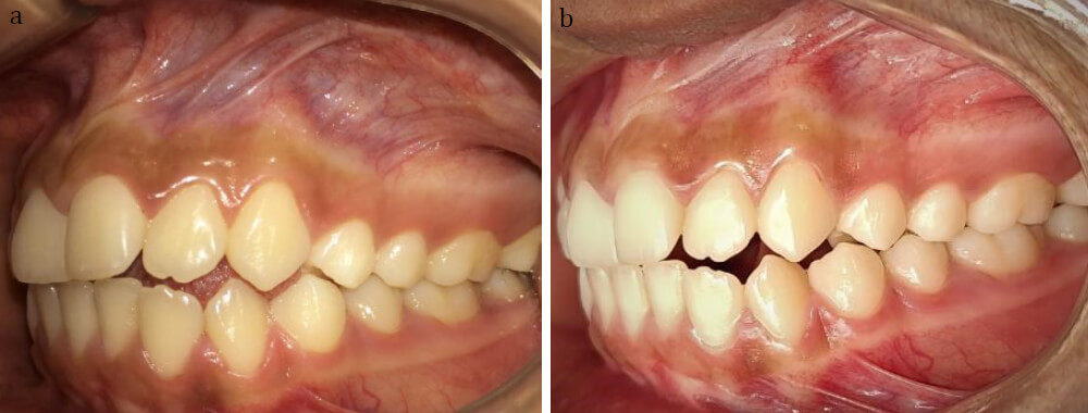 Figura 6: Fotografía Postoperatoria (a) 6 meses, (b) 12 meses.