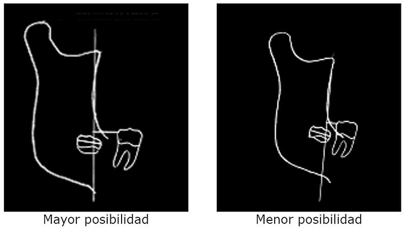 El tercer molar mandibular, método predictivo de erupción