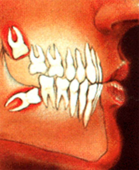 El tercer molar mandibular, método predictivo de erupción