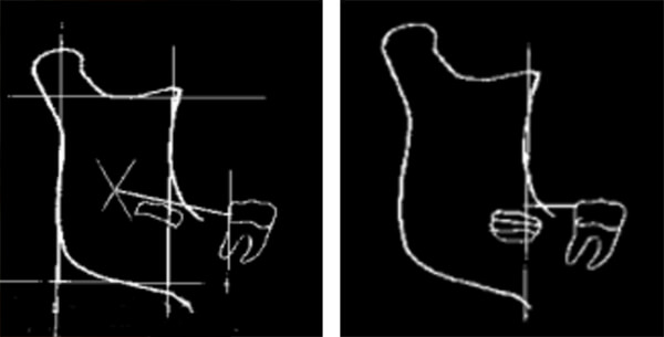 El tercer molar mandibular, método predictivo de erupción