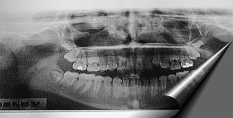 El tercer molar mandibular, método predictivo de erupción