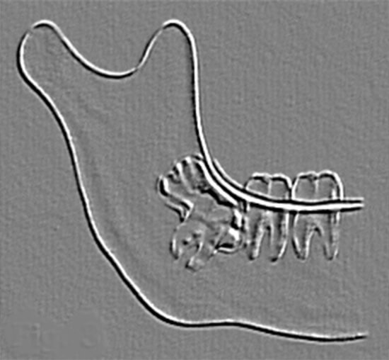 El tercer molar mandibular, método predictivo de erupción