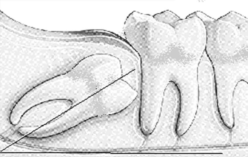 El tercer molar mandibular, método predictivo de erupción