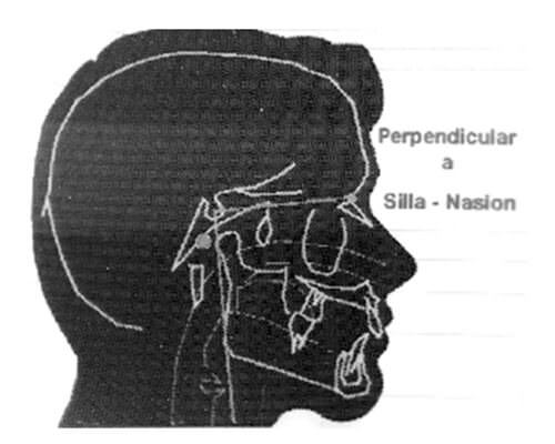 Fig. 1 Perpendicular a silla Nasion