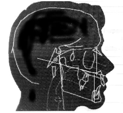 Fig. 4 Alturas faciales superiores e inferiores