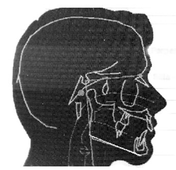 Fig. 6 Plano mandibular