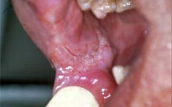 Fig. 3: Aspecto clínico intrabucal de lesión en cavidad bucal