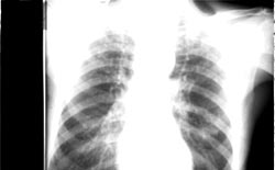 Fig. 5: Aspecto radiográfico (Rx. de torax) del paciente