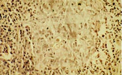 Fig. 6: Histopatología con coloración de hematoxilina, eosina del paciente