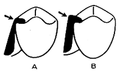 Fig. 5: A.-Sin la adecuada preparación del descanso (reducción del reborde marginal), puede resultar en áreas delgadas; B.- Un espesor mínimo de 1,5 mm es necesario para para prevenir la fractura. Jacobson,(1988