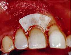 5b. Colocación de membrana angosta para dientes anteriores de la casa Gore Tex®.