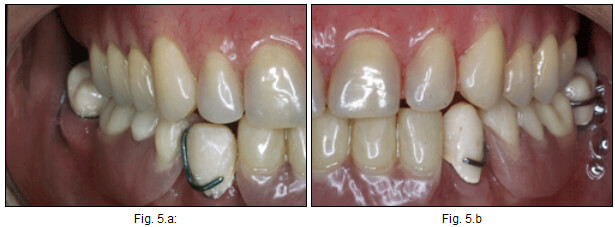 Fig. nº 5: Vista clínica del paciente con prótesis provisionales fija y removible en el maxilar inferior y sobredentadura total superior.