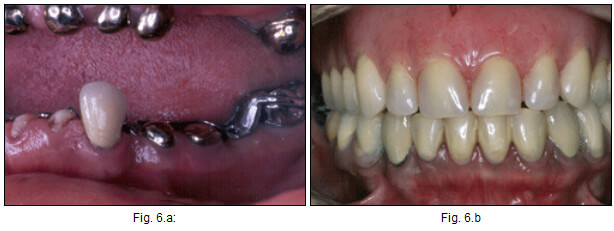 Fig. Nº6: A, vista clínica del caso con la estructura de la prótesis parcial removible inferior, nótese el efecto estético de esta y las restauraciones de los dientes pilares. B vista intrabucal del caso terminado.