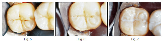 Lesiones cariosas en un paciente de alto riesgo. Se utilizó una fresa redonda de 1/8 para abrir la fisura y examinar la extensión de la caries. Se obturó con un sellante de puntos y fisuras