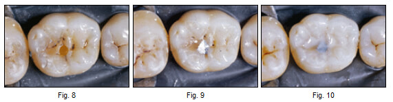 Eliminación de caries en la fosa central, la cual se restauró con amalgama. Aplicando un concepto actual de extensión por prevención en el resto de la fisura se utilizó un sellante de puntos y fisuras.