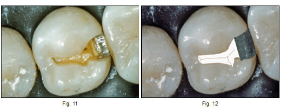 Cavidad de la Clase II en un premolar realizada con los conceptos tradicionales de extensión por prevención. La figura 12 es una imagen generada por computador que indica la forma de tratamiento actual: una cavidad próximal única y sellante de puntos y fisuras en oclusal.