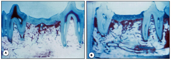 Figura 1: Cortes histológicos que muestran un plano mesiodistal de mandíbulas tratadas ortodóncicamente en un grupo experimental (A) y en un control (B). Nótese la pérdida ósea trabecular en el grupo experimental. Tomado de: Midgett y col. 1981.