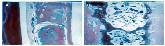 Figura 2: Corte histológico de un área interproximal de un primer y segundo molar maxilar. A: grupo control; B: grupo experimental tratado con cortisona. Note la diferencia en la densidad ósea, al igual que el escaso trabeculado y gran número de osteoclastos en sus lagunas reabsortivas en el grupo experimental. Tomado de: Ashcraft y col., 1992.