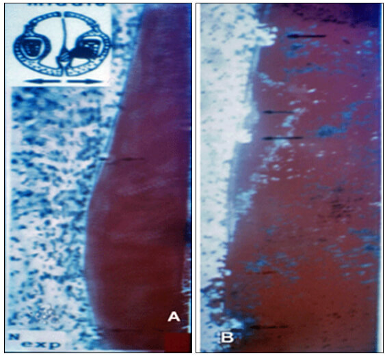 Figura 3: Cortes histológicos longitudinales de la región periodontal de un incisivo superior, pertenecientes a una rata normal (A) y a una hipocalcémica (B). Note la presencia de reabsorciones radiculares en ambos casos, siendo más extensas en el animal experimental. Tomado de: Engström y col., 1988