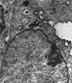 Fig. 1: Células de la línea carcinomatosa. Nótese en ellas: desmosoma (flecha), mitocondrias hinchadas (asterisco), polisomas libres (circulo), cisternas del retículo endoplasmático rugoso (cabeza de flecha), núcleo con nucleolo periférico (rombo), prolongación citoplasmática filiforme (estrella) X.18.000