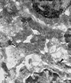 Fig. 2: Células de la línea carcinomatosa. En ellas las flechas señalan desmosomas y la cabeza de flecha muestra filamentos de citoqueratina X. 24.000