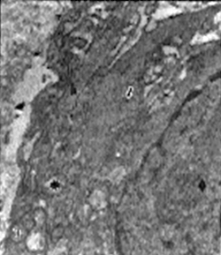 Fig. 3: Célula de la línea sarcomatosa. En ella: núcleo con nucleolo alargado (rombo), mitocondrias hinchadas (asterisco), cisternas del retículo endoplasmático (cabeza de flecha) y densidades focales (flecha) X. 24.000
