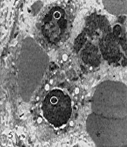 Fig. 5: Nótese la presencia de células tumorales (circulos) dentro de un capilar sanguíneo. La flecha señala la célula endotelial X. 9.000