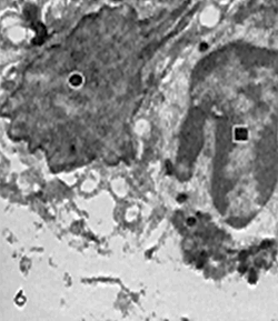 Fig. 6: Un neutrófilo (cuadrado) se encuentra ubicado al lado de una célula tumoral (circulo) X. 15.000 