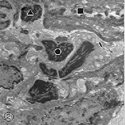 Fig. 2. En esta micrografía electrónica, flecha: mitocondria; círculo: núcleo picnótico; triángulo: linfocito. Aumento: 9000x