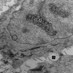 Fig. 3. En esta micrografía electrónica, nu: nucléolo; círculo: borde nuclear sin heterocromatina; cuadrado: espongiosis. Aumento: 15000x