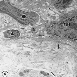 Fig. 4. En esta micrografía electrónica, nu: nucléolo; círculo: núcleo de célula aparentemente maligna; triángulo: linfocito. Note la presencia de hemidesmosomas (cabeza de flecha). Aumento: 9000x